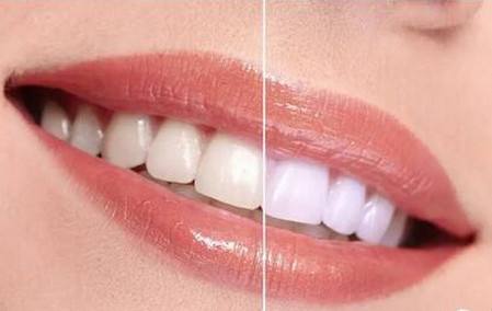 牙齒太黃要變白的問(wèn)題-成都種植牙廠家