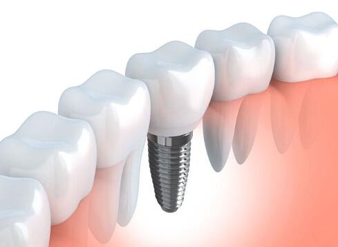 整個(gè)種植牙修復(fù)過程要多久-四川義齒廠家