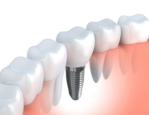 整個(gè)種植牙修復(fù)過程要多久-四川義齒廠家