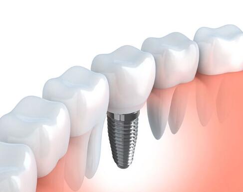 整個種植牙修復(fù)過程要多久-四川義齒廠家