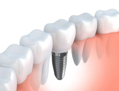 整個種植牙修復過程要多久-四川義齒廠家