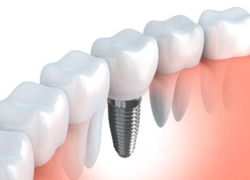 整個(gè)種植牙修復(fù)過(guò)程要多久-四川義齒廠(chǎng)家