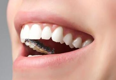 做種植牙修復(fù)脫落牙齒的優(yōu)點(diǎn)有哪些-成都種植牙廠家