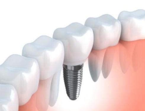整個(gè)種植牙修復(fù)過(guò)程要多久-四川義齒廠家