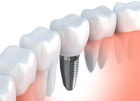 整個(gè)種植牙修復(fù)過程要多久-四川義齒廠家