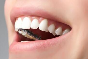 做種植牙修復(fù)脫落牙齒的優(yōu)點有哪些-成都種植牙廠家