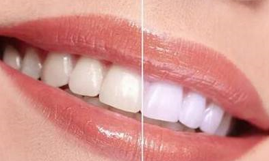 牙齒太黃要變白的問題-成都種植牙廠家