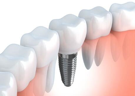 整個種植牙修復(fù)過程要多久-四川義齒廠家