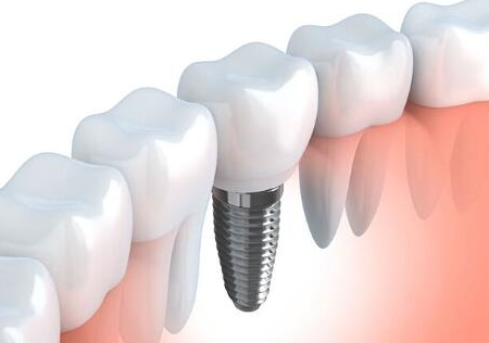 整個(gè)種植牙修復(fù)過(guò)程要多久-四川義齒廠家