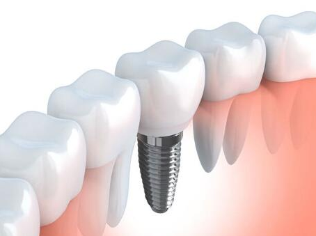 整個(gè)種植牙修復(fù)過程要多久-四川義齒廠家