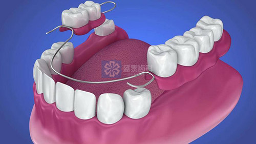 成都義齒廠家：專業(yè)品質(zhì)，成就您的微笑夢想